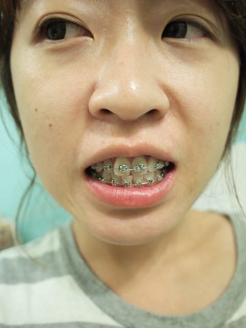 [牙套日記] 牙套米展開新生活囉!!!