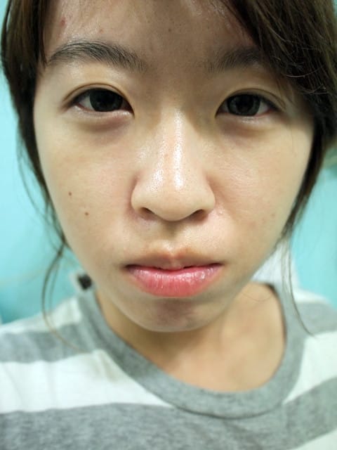 [牙套日記] 牙套米展開新生活囉!!!