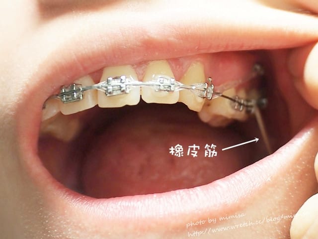 [牙套日記] 我最終還是打骨釘了
