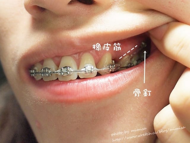 [牙套日記] 我最終還是打骨釘了