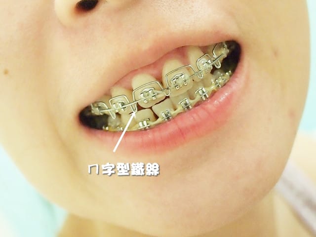[牙套日記] 不知不覺已經過了半年嚕!!! 牙兒你要快快跑唷!!!
