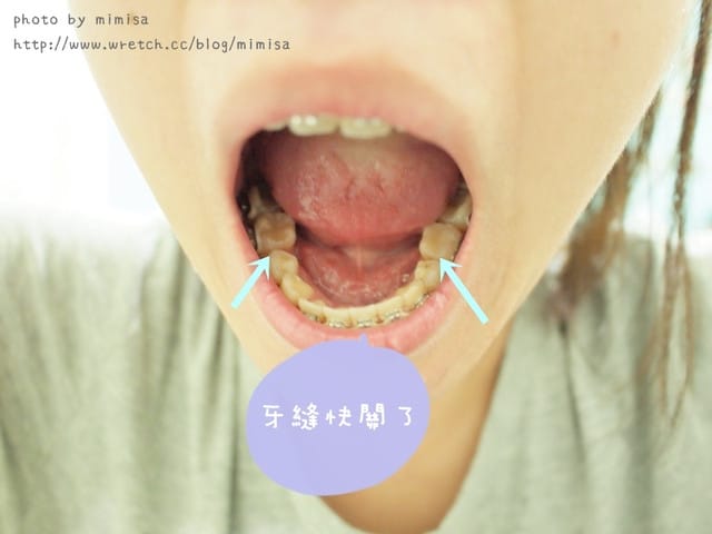 [牙套日記] 啟動新裝置，即將邁入1年啦!!!!