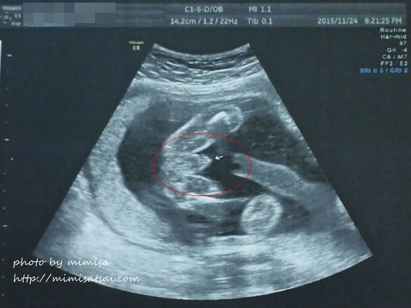 [孕日記] 小籽兒的性別之謎要揭曉囉!!!是雪兒還是賴虎呢???