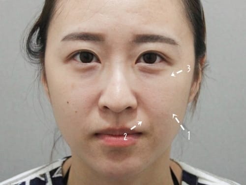 [醫美] 聖宜診所新竹店。V無痕音波讓我擺脫鬆垮老皮臉