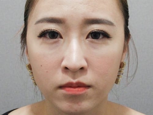 [醫美] 聖宜診所新竹店。V無痕音波讓我擺脫鬆垮老皮臉