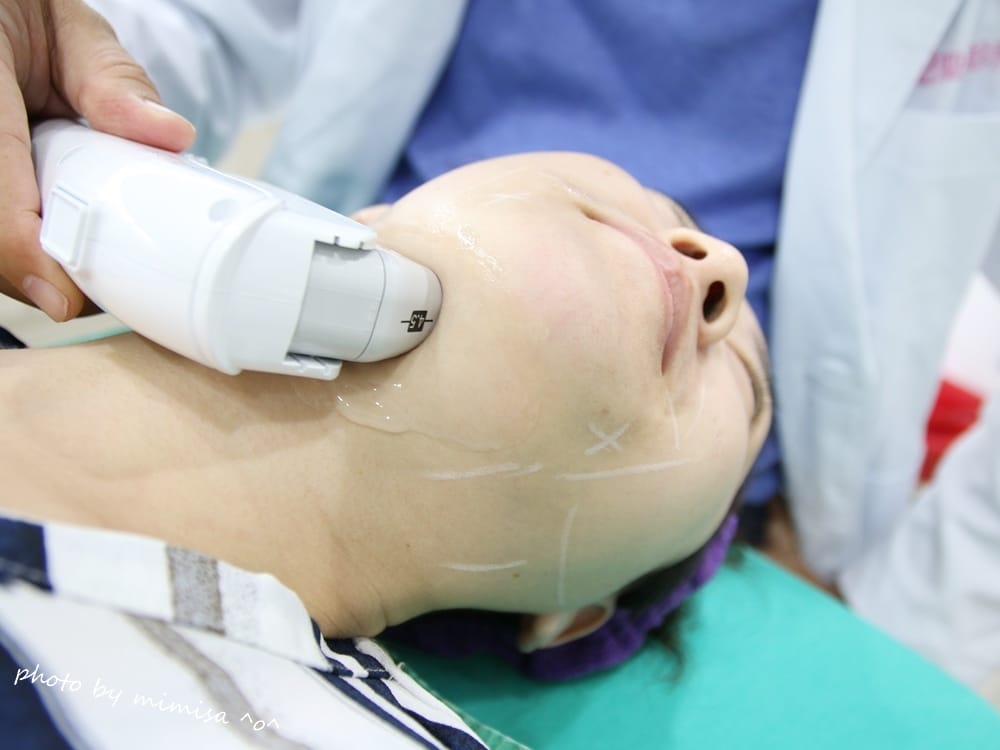 [醫美] 聖宜診所新竹店。V無痕音波讓我擺脫鬆垮老皮臉