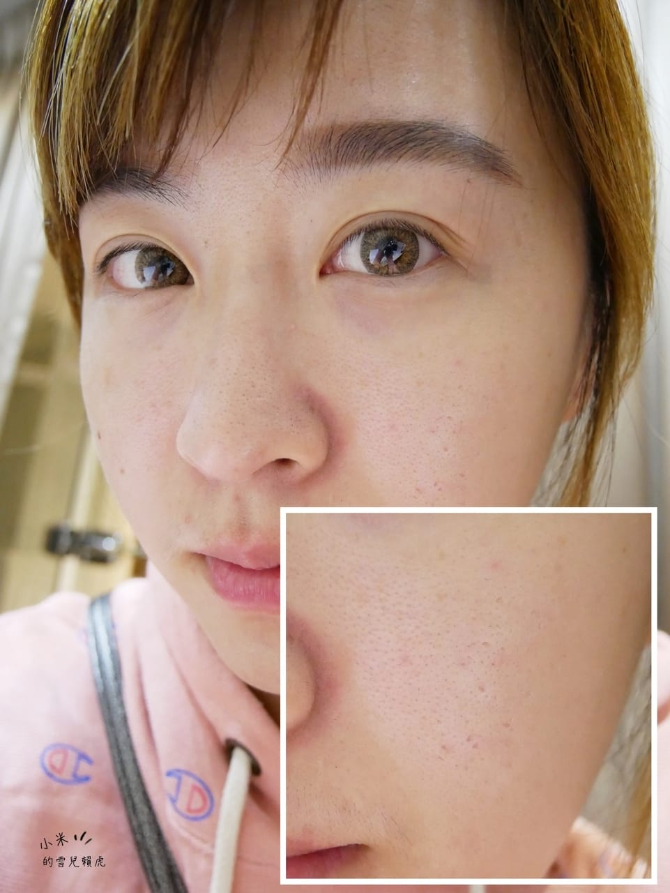 [醫美] 聖宜診所新竹店。讓皮秒雷射成就我的水煮蛋肌!!!