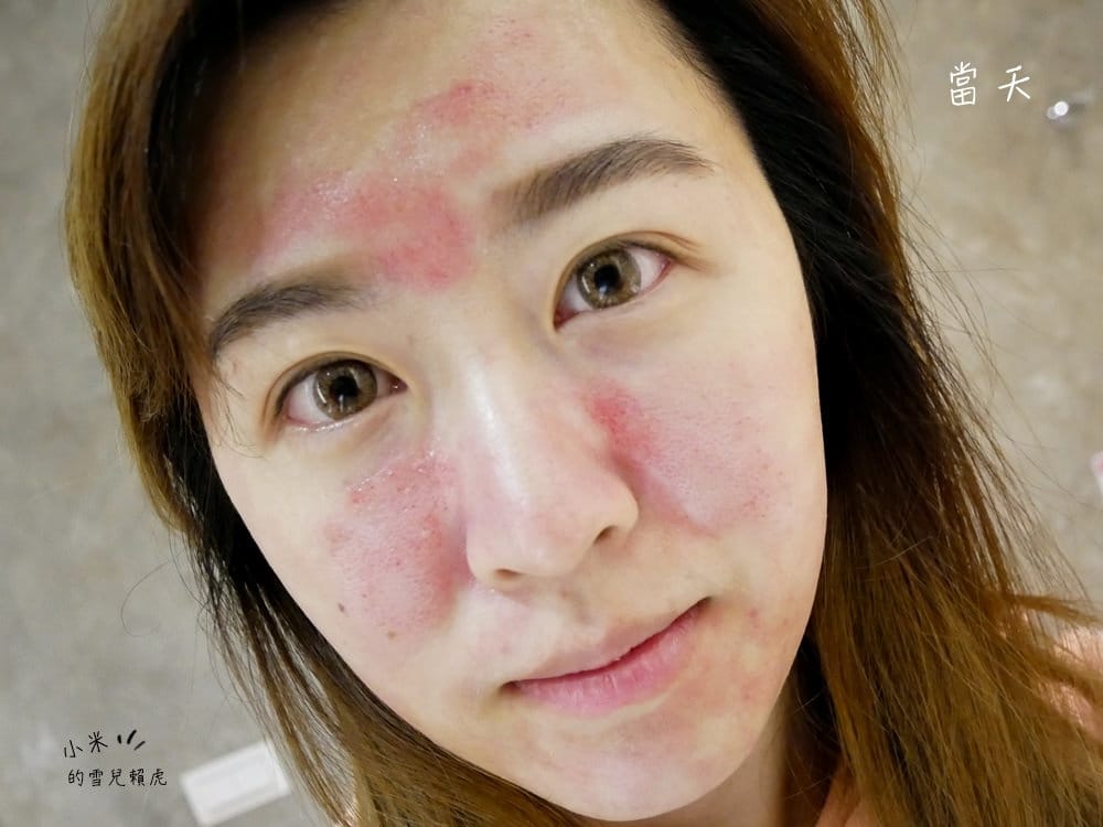 [醫美] 聖宜診所新竹店。讓皮秒雷射成就我的水煮蛋肌!!!