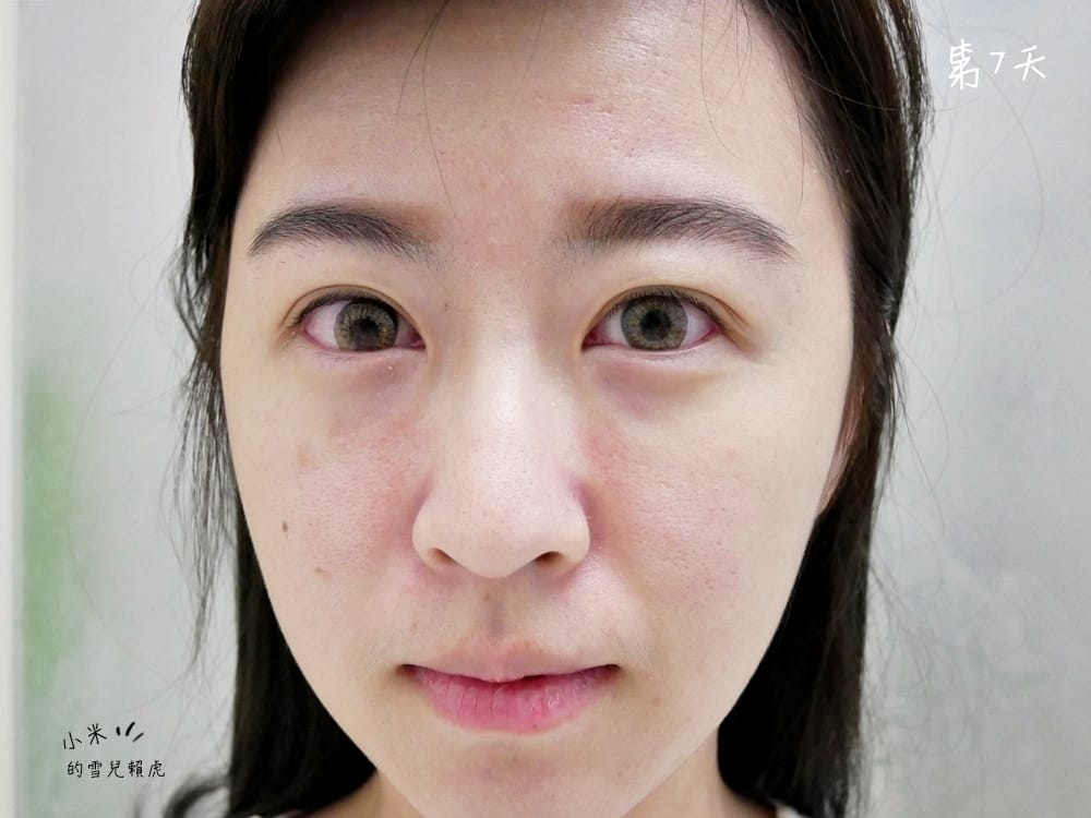 [醫美] 聖宜診所新竹店。讓皮秒雷射成就我的水煮蛋肌!!!