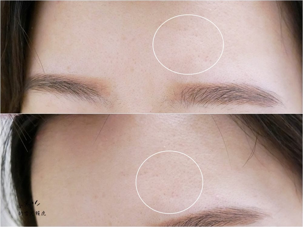 新竹聖宜診所 皮秒雷射 (19)