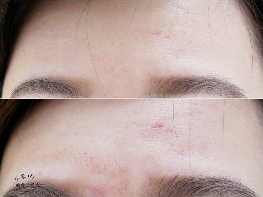 [醫美] 聖宜診所新竹店。讓皮秒雷射成就我的水煮蛋肌!!!