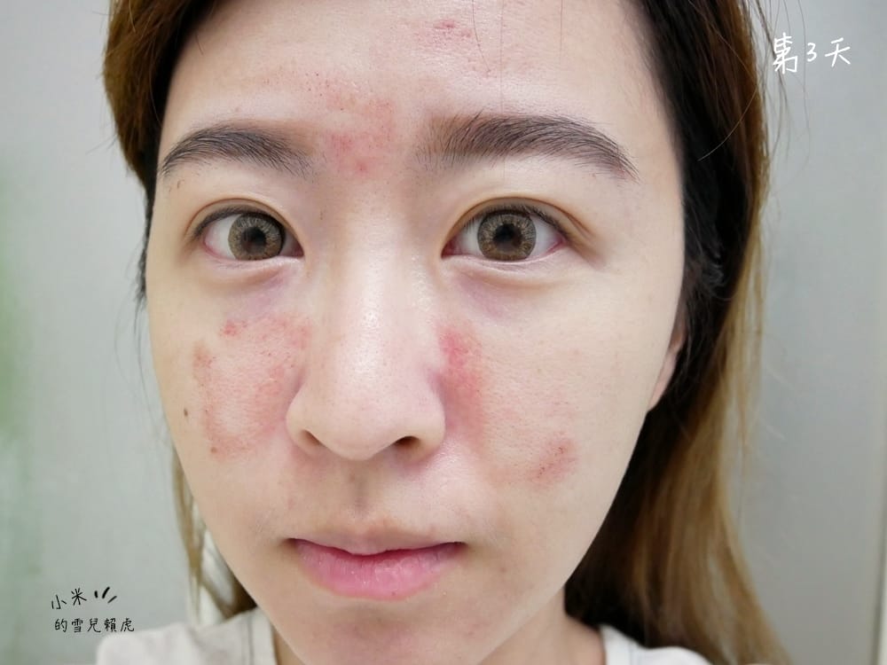 [醫美] 聖宜診所新竹店。讓皮秒雷射成就我的水煮蛋肌!!!