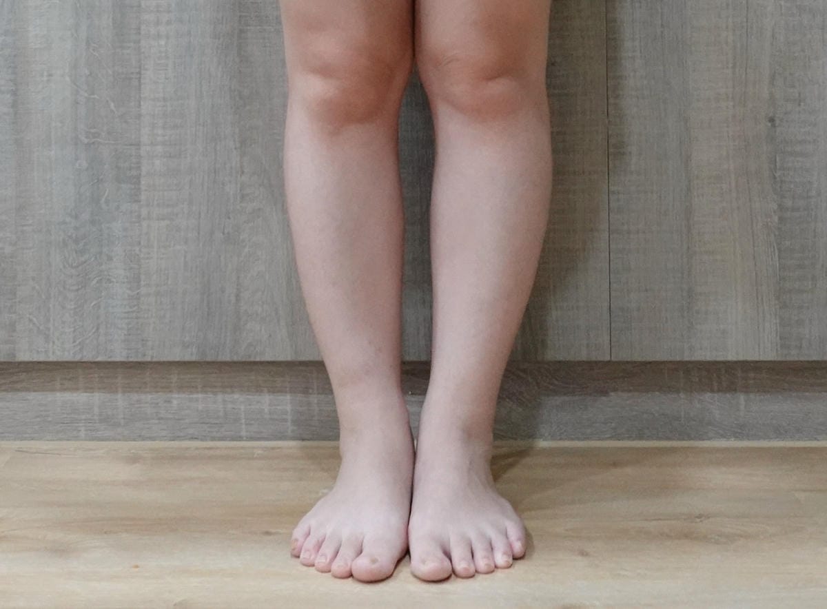悠美診所肉毒小腿 (24).jpg 悠美診所肉毒小腿 (24).jpg