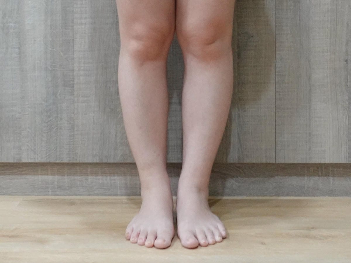 悠美診所肉毒小腿 (18).jpg 悠美診所肉毒小腿 (18).jpg