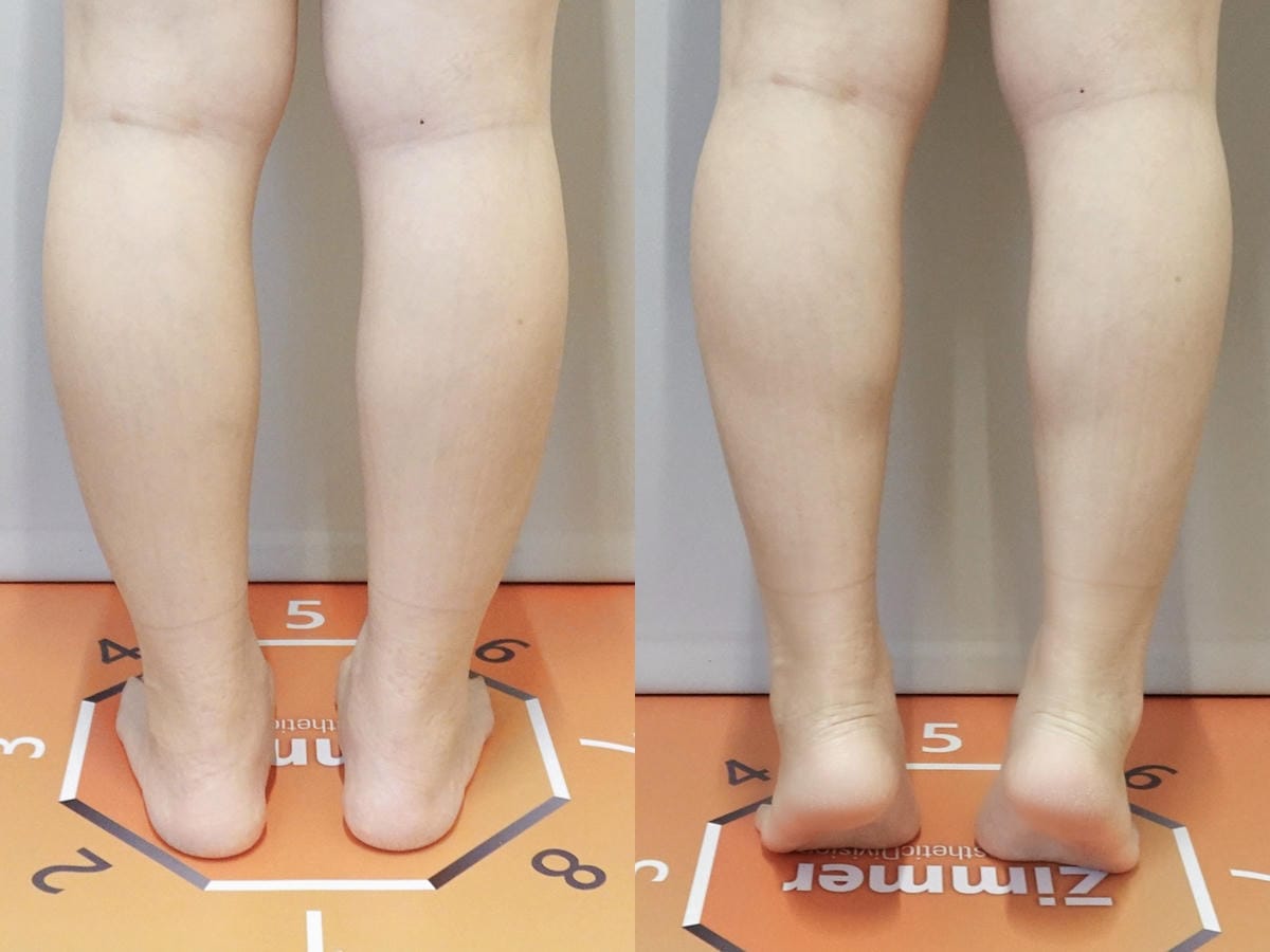 悠美診所肉毒小腿 (15).jpg 悠美診所肉毒小腿 (15).jpg