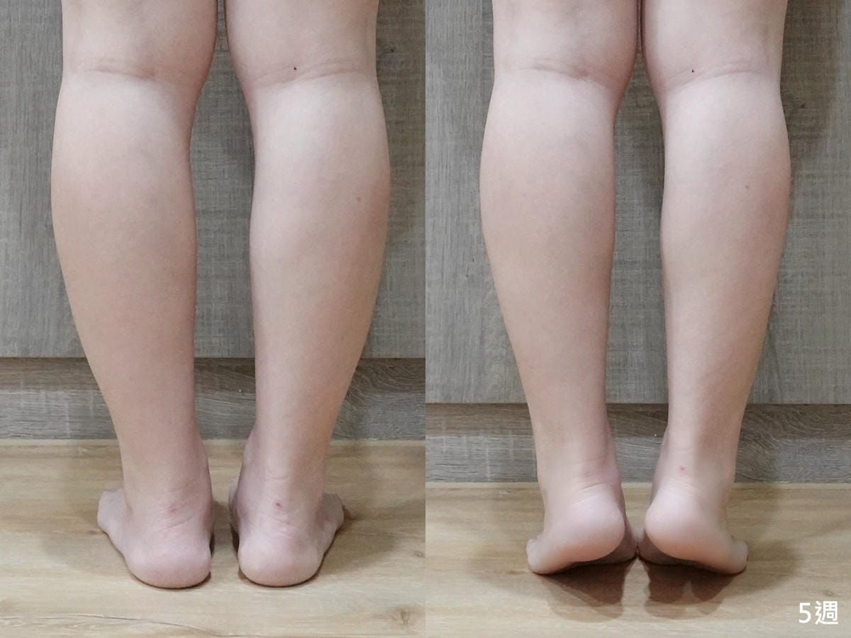 悠美診所肉毒小腿 (19).jpg 悠美診所肉毒小腿 (19).jpg