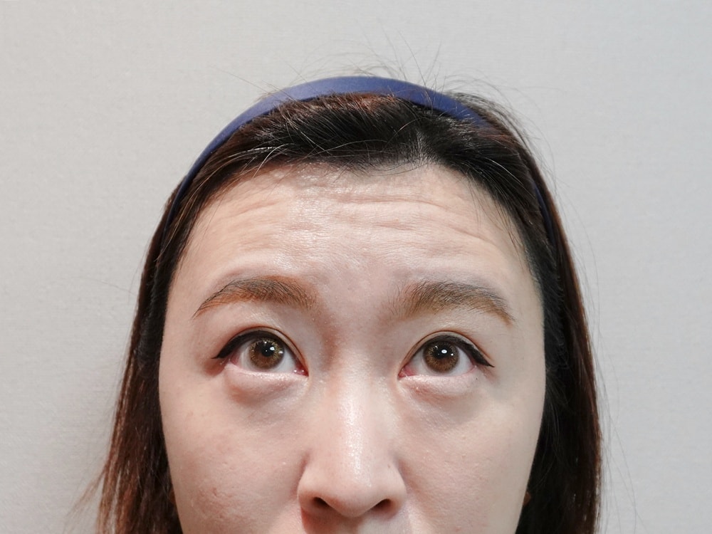 台北琢月診所。NABOTA彩虹肉毒讓我找回自信的笑容。