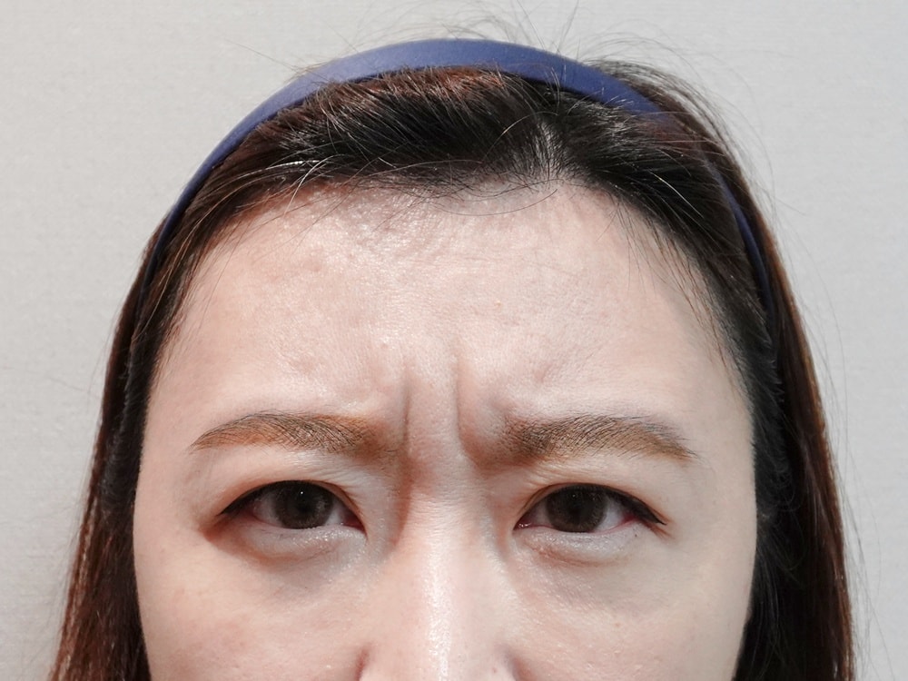 台北琢月診所。NABOTA彩虹肉毒讓我找回自信的笑容。